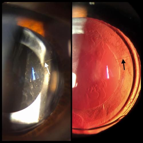 Artificial intraocular lens in the posterior chamber - toric